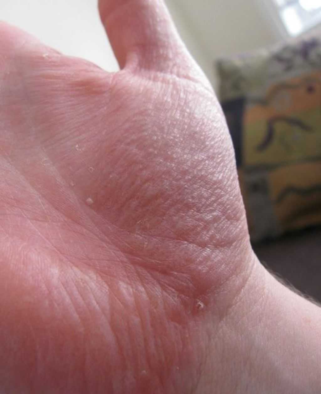 Почему чешутся пальцы на левой руке. Дисгидротическая дерматофития.