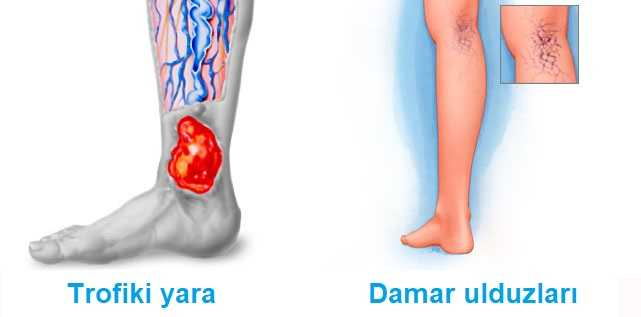 Трофические язвы на ногах: симптомы и лечение