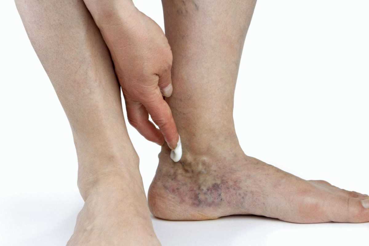 Лечение трофических язв на ногах народными средствами – длительный, но эффективный процесс благодаря которому не остается рубцов Узнайте лучшие рецепты