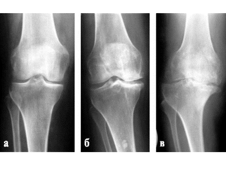 Диагноз доа суставов. Гонартроз 2 степени коленного сустава рентген. Деформирующий гонартроз рентген. Гонартроз коленного сустава 1 степени на рентгене. Гонартроз 1 степени на рентгене.