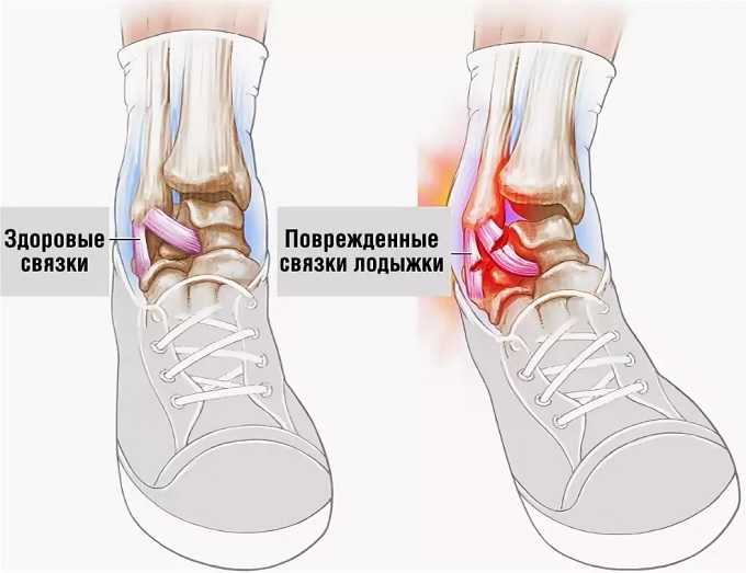 Растяжение сухожилий, связок, мышц, суставов: лечение растяжения и первая помощь – напоправку