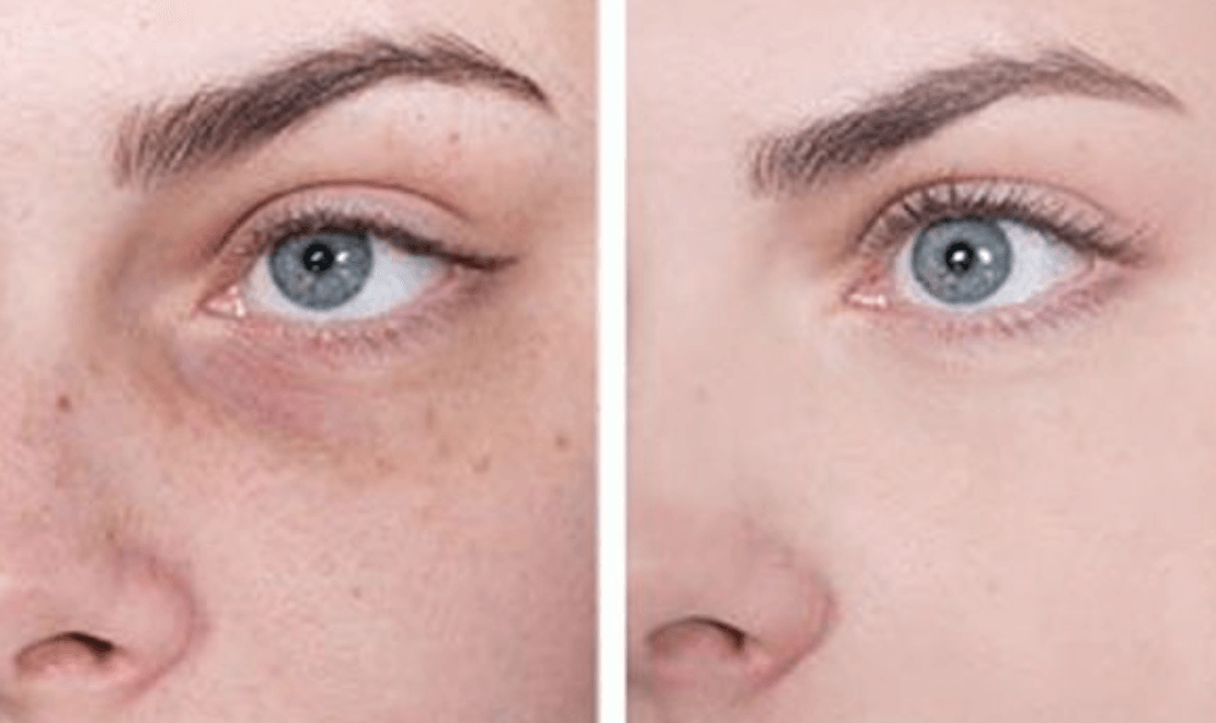 Как убрать синяки под глазами косметология до и после фото
