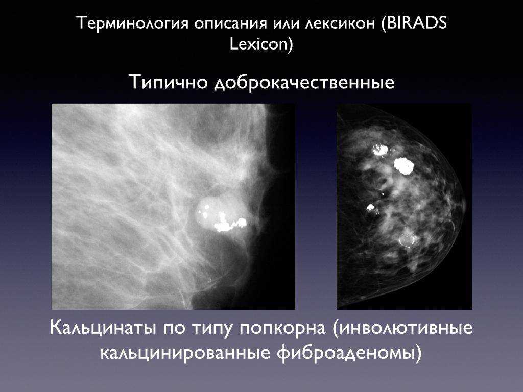 Маммография ответы. Маммография раковые микрокальцинаты. Микрокальцинаты молочной железы рентген. Микрокальцинаты в молочной железе рентген. РМЖ кальцинаты маммограмма.