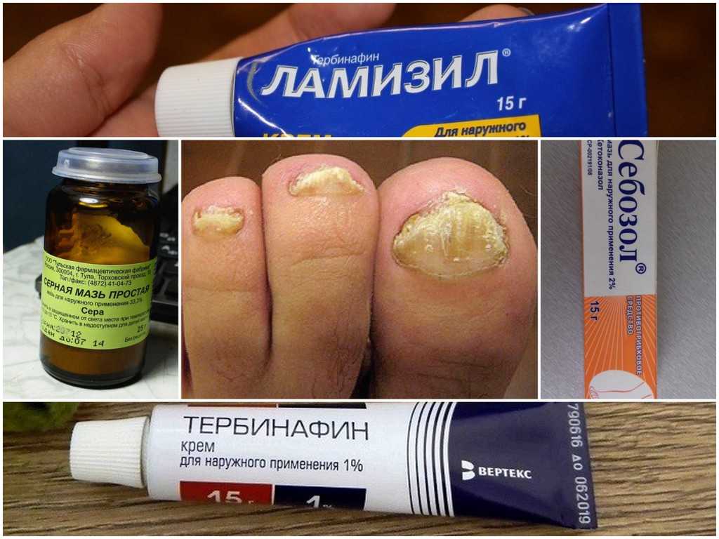Грибок кожи лечение препараты недорогие но эффективные. Мазь от грибка ногтей на ногах.