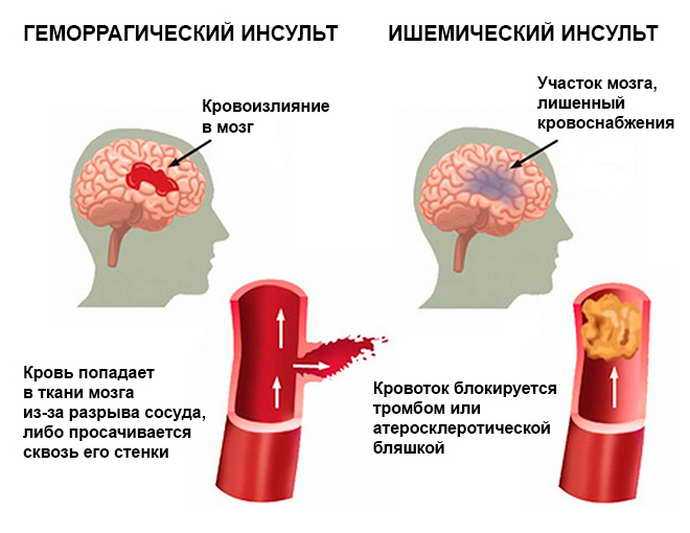Инсульт правая сторона мозга последствия