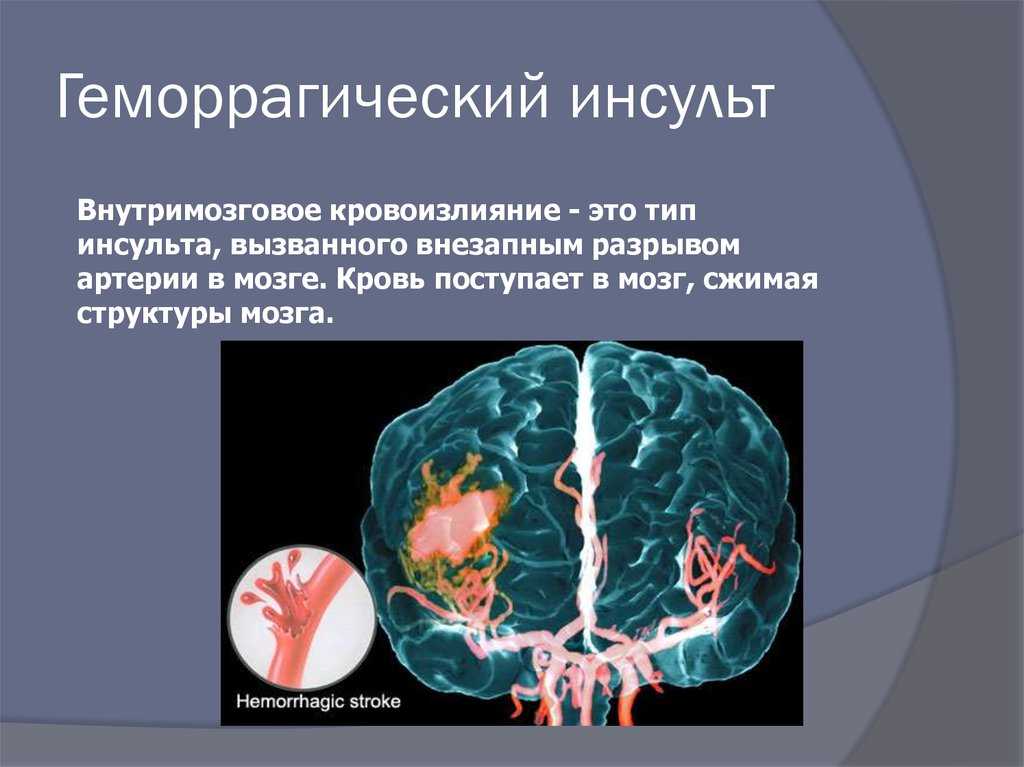Зона инсульта. Внутримозговое кровоизлияние инсульт. Внутримозговой геморрагический инсульт. Кровоизлияние в мозг это инсульт. Геморрагический инсульт кровоизлияние в мозг.