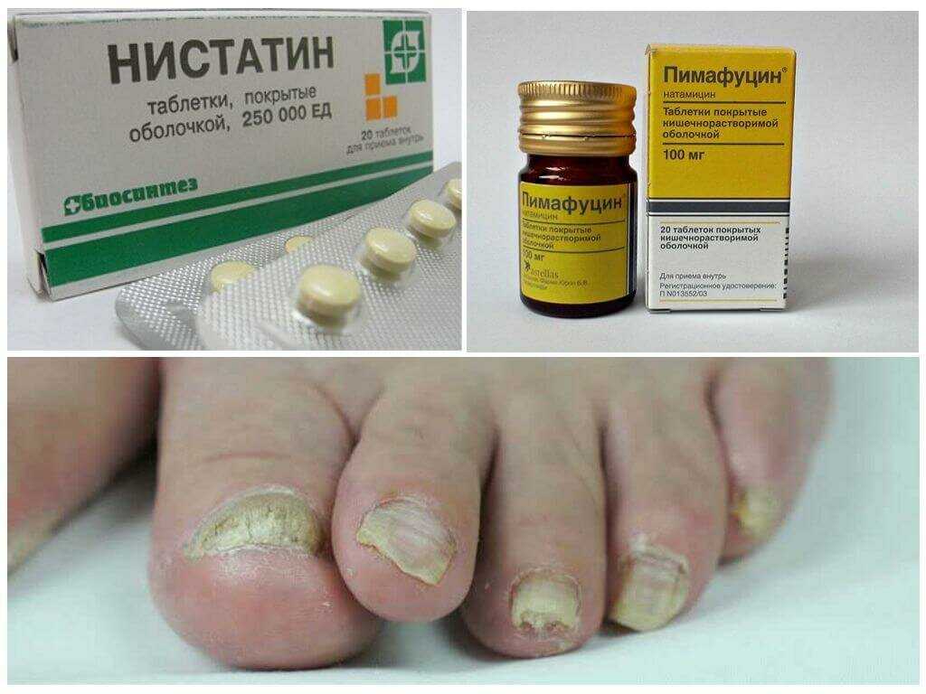 Микоз полового члена. причины, симптомы и лечение микоза полового члена
