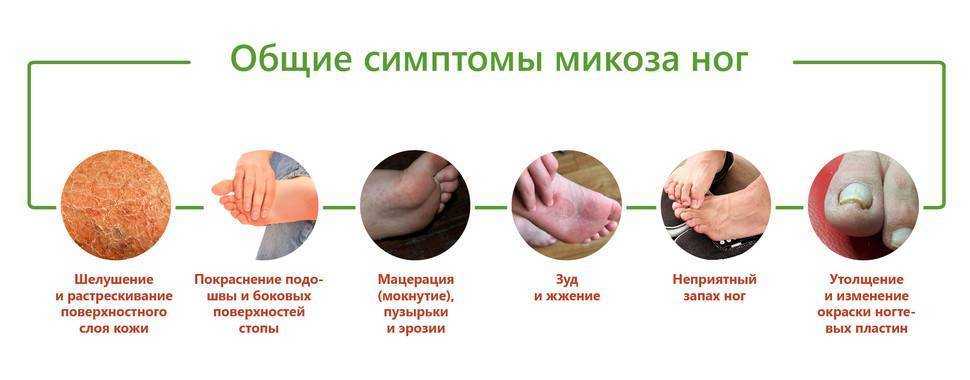 Узнайте, какое выбрать средство от грибка на ногах между пальцами, чтобы эффективно устранить проблему, зуд и жжение Правильно подобранные препараты быстро справятся с болезнью