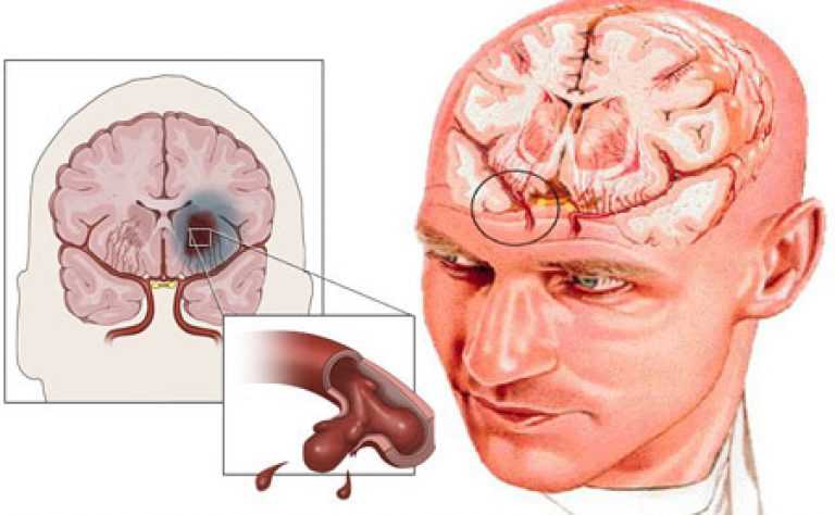 Ишемия мозга последствия у взрослых. Геморрагический инсульт с кровоизлиянием в головной мозг. ОНМК ишемический и геморрагический инсульт. Поражение головного мозга геморрагический инсульт. Острое нарушение мозгового кровообращения геморрагический инсульт.