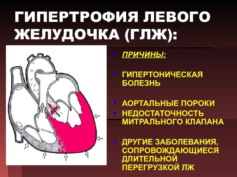 Миокард правого желудочка сердца. Гипертоническая болезнь и гипертрофия левого желудочка. Левожелудочковая гипертрофия. Гипертрофия левого желудочка этиология. Для гипертрофии миокарда левого желудочка характерно.