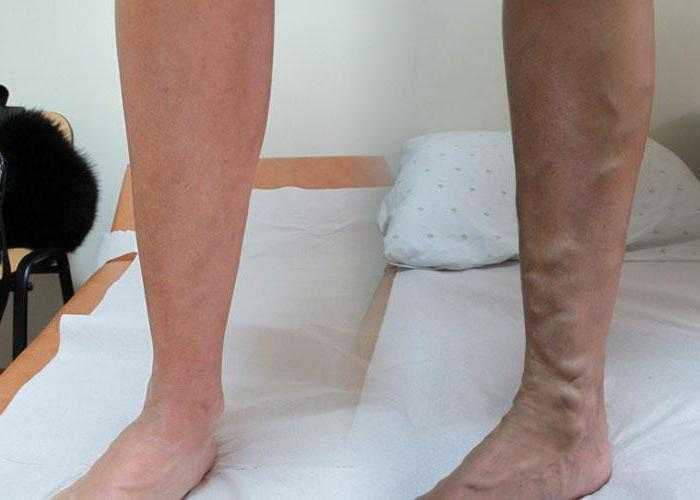 Трофические язвы на ногах при варикозной болезни ⋆ varicose.kiev.ua