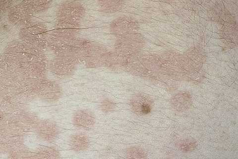 Кератоз кожи: виды, причины и методы лечения