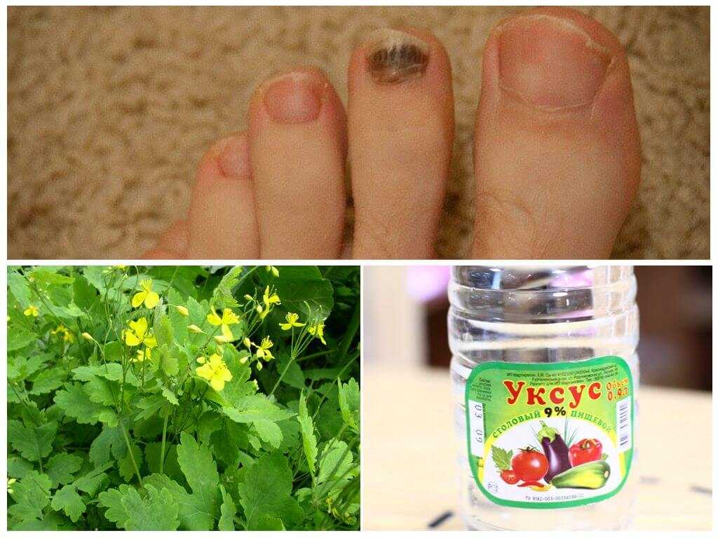 Лечение чистотелом в домашних. Грибок ногтей народные средства. Средство для грибка ногтей на ногах.